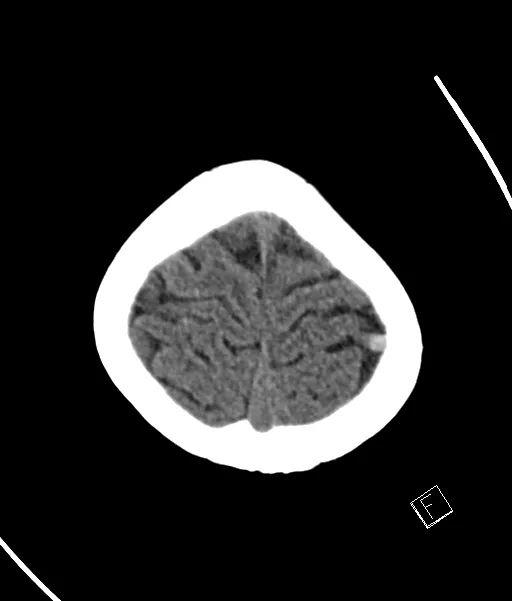 影像PPT - 【病例】静脉血栓形成伴梗死/出血2例CT及MR-50 影像PPT - 【病例】静脉血栓形成伴梗死/出血2例CT及MR-50