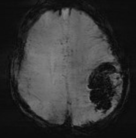 影像PPT - 【病例】静脉血栓形成伴梗死/出血2例CT及MR-65 影像PPT - 【病例】静脉血栓形成伴梗死/出血2例CT及MR-65