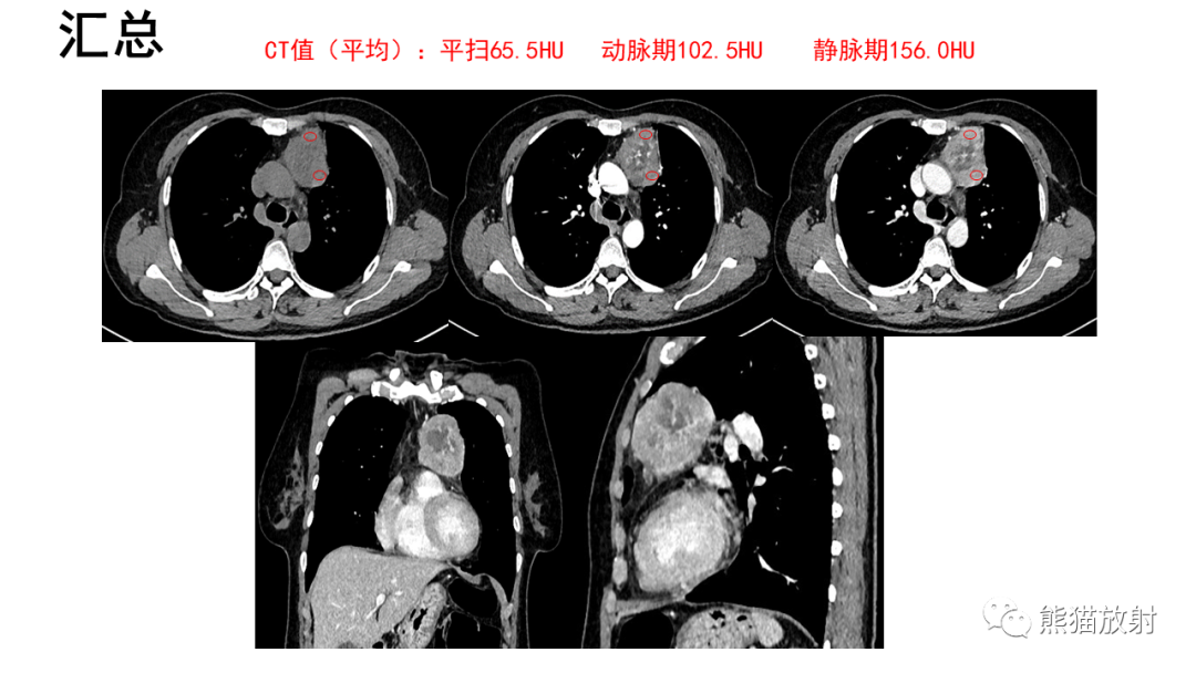 影像PPT - 【病例】胸腺神经内分泌肿瘤2例CT影像-10