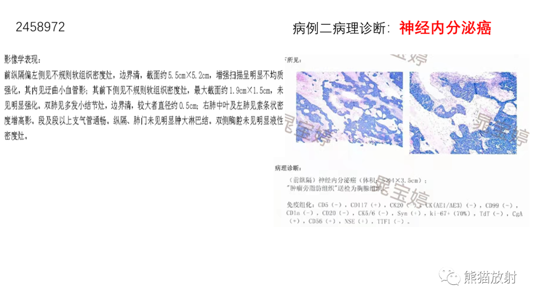 影像PPT - 【病例】胸腺神经内分泌肿瘤2例CT影像-15