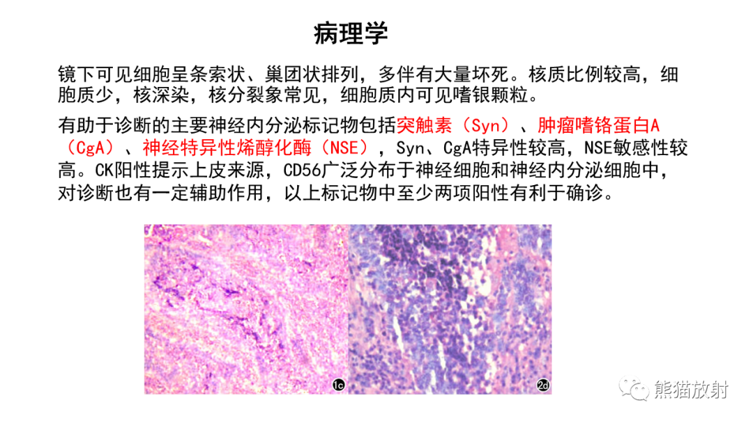 影像PPT - 【病例】胸腺神经内分泌肿瘤2例CT影像-21