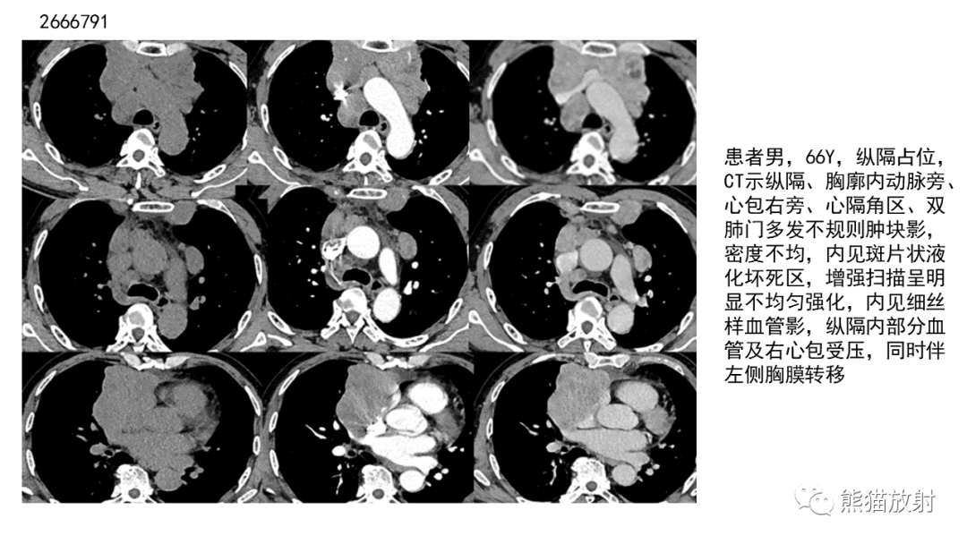 影像PPT - 【病例】胸腺神经内分泌肿瘤2例CT影像-23
