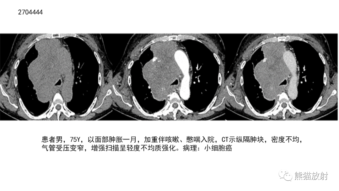 影像PPT - 【病例】胸腺神经内分泌肿瘤2例CT影像-24