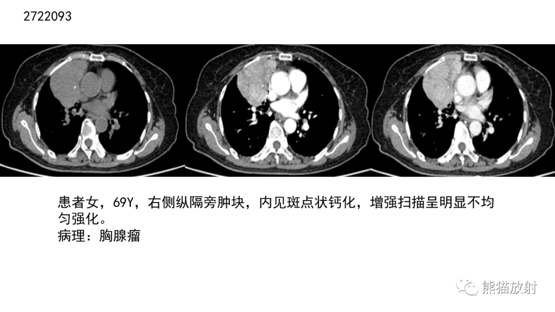 影像PPT - 【病例】胸腺神经内分泌肿瘤2例CT影像-29