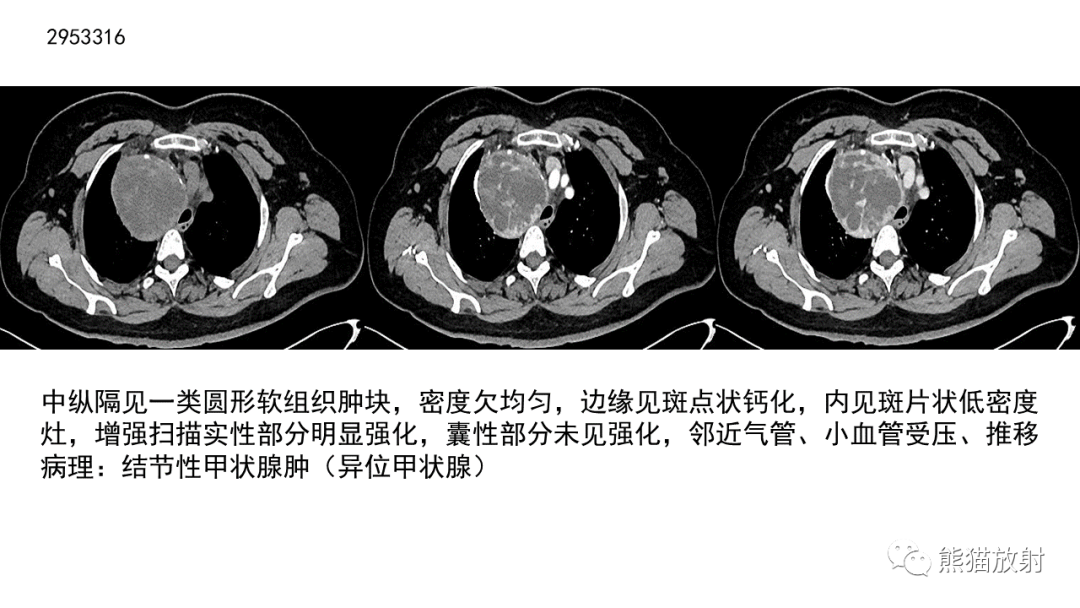 影像PPT - 【病例】胸腺神经内分泌肿瘤2例CT影像-33