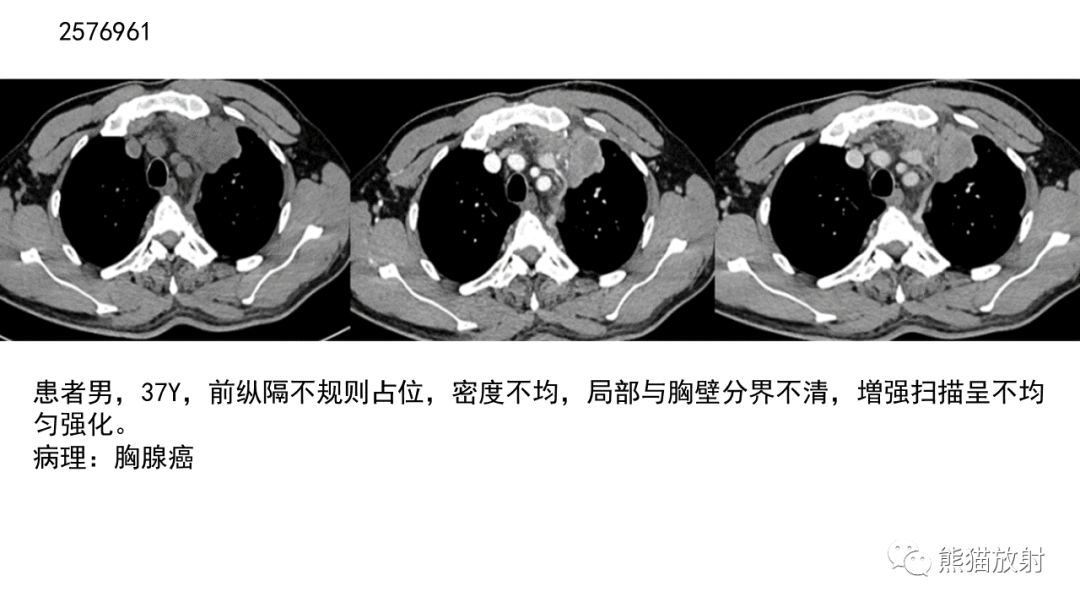 影像PPT - 【病例】胸腺神经内分泌肿瘤2例CT影像-31