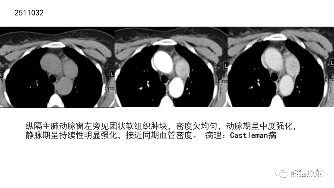 影像PPT - 【病例】胸腺神经内分泌肿瘤2例CT影像-35