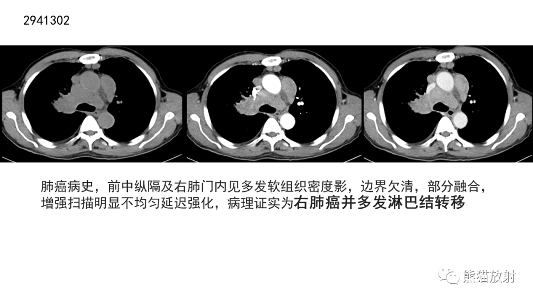 影像PPT - 【病例】胸腺神经内分泌肿瘤2例CT影像-37