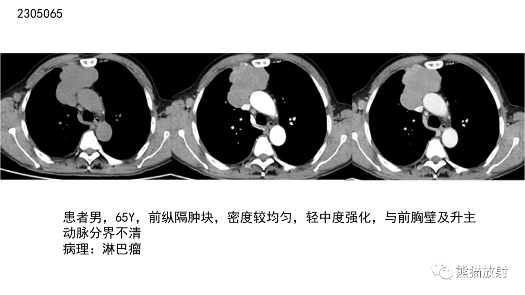 影像PPT - 【病例】胸腺神经内分泌肿瘤2例CT影像-39