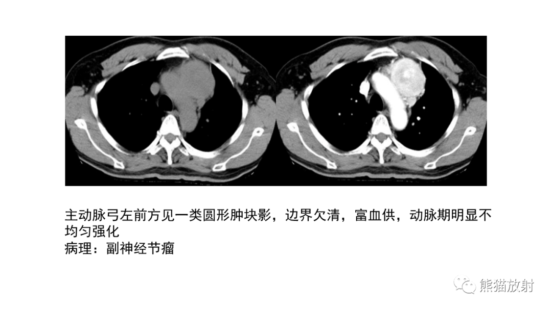 影像PPT - 【病例】胸腺神经内分泌肿瘤2例CT影像-41