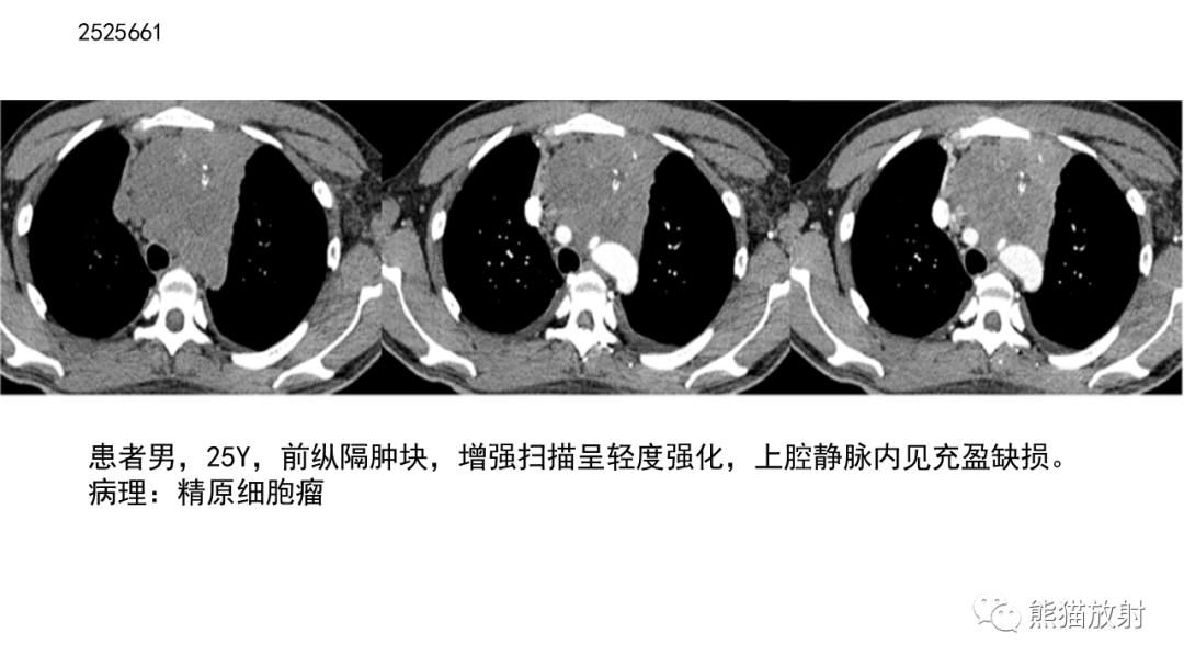 影像PPT - 【病例】胸腺神经内分泌肿瘤2例CT影像-43