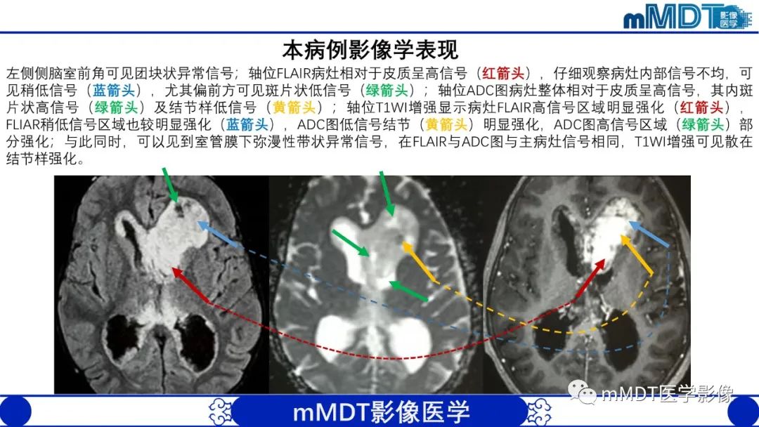 影像PPT - 【病例】脑室内毛细胞星形细胞瘤伴室管膜下转移1例MR影像-4