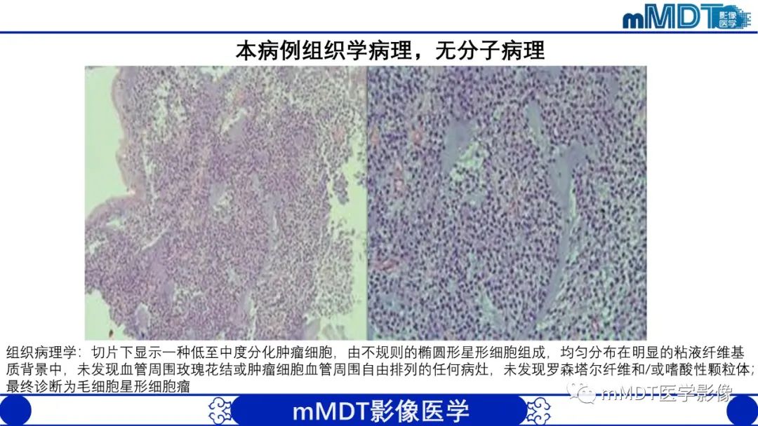 影像PPT - 【病例】脑室内毛细胞星形细胞瘤伴室管膜下转移1例MR影像-6