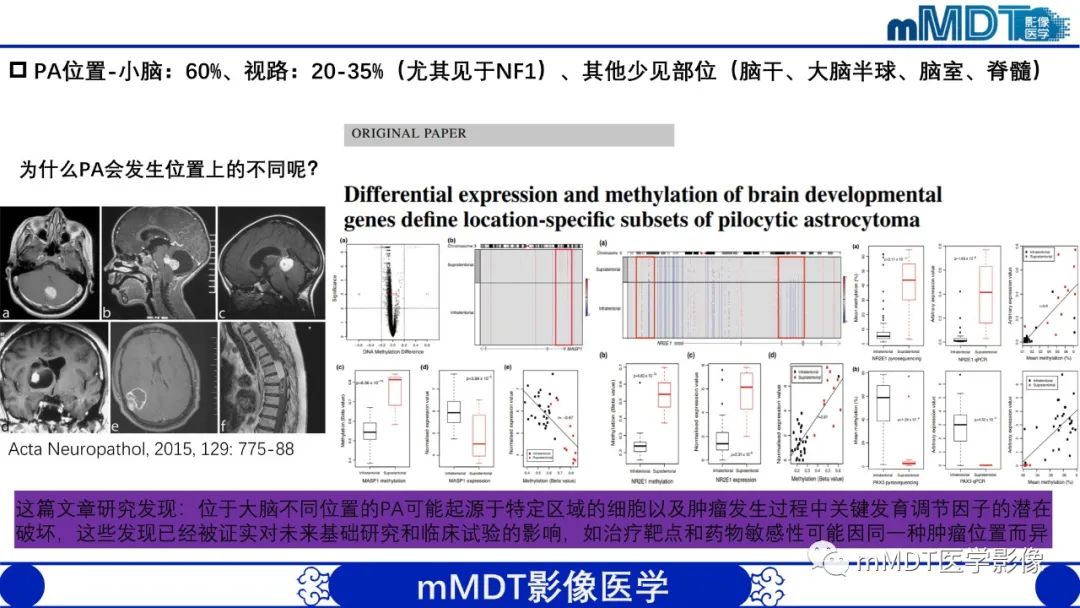 影像PPT - 【病例】脑室内毛细胞星形细胞瘤伴室管膜下转移1例MR影像-10