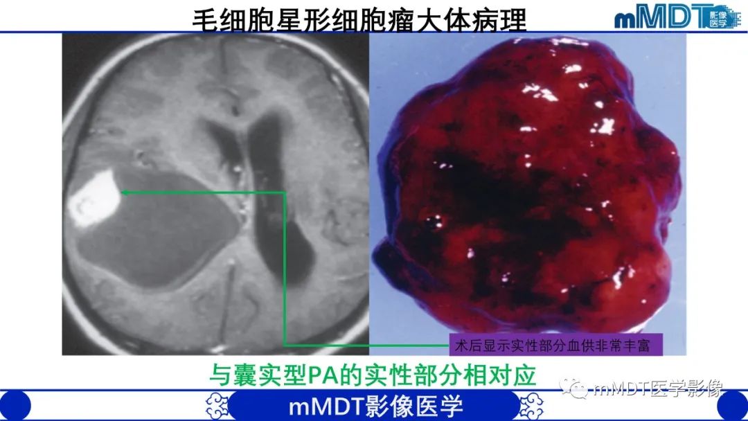 影像PPT - 【病例】脑室内毛细胞星形细胞瘤伴室管膜下转移1例MR影像-11