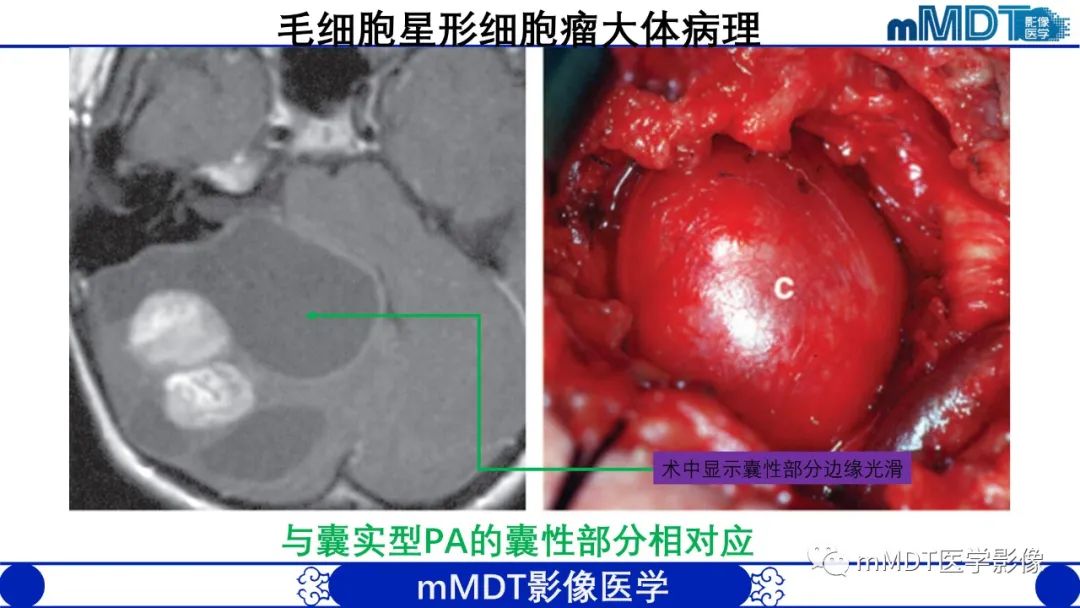 影像PPT - 【病例】脑室内毛细胞星形细胞瘤伴室管膜下转移1例MR影像-12