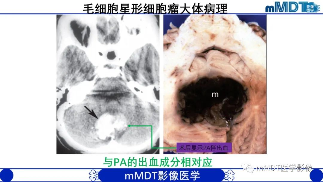 影像PPT - 【病例】脑室内毛细胞星形细胞瘤伴室管膜下转移1例MR影像-13