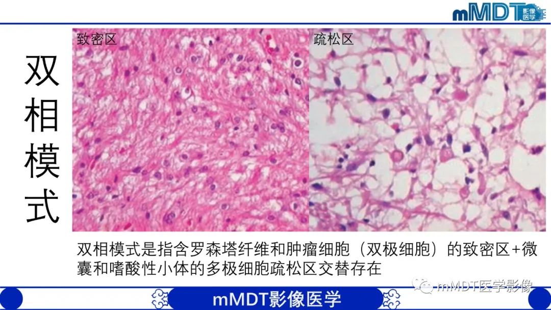 影像PPT - 【病例】脑室内毛细胞星形细胞瘤伴室管膜下转移1例MR影像-17