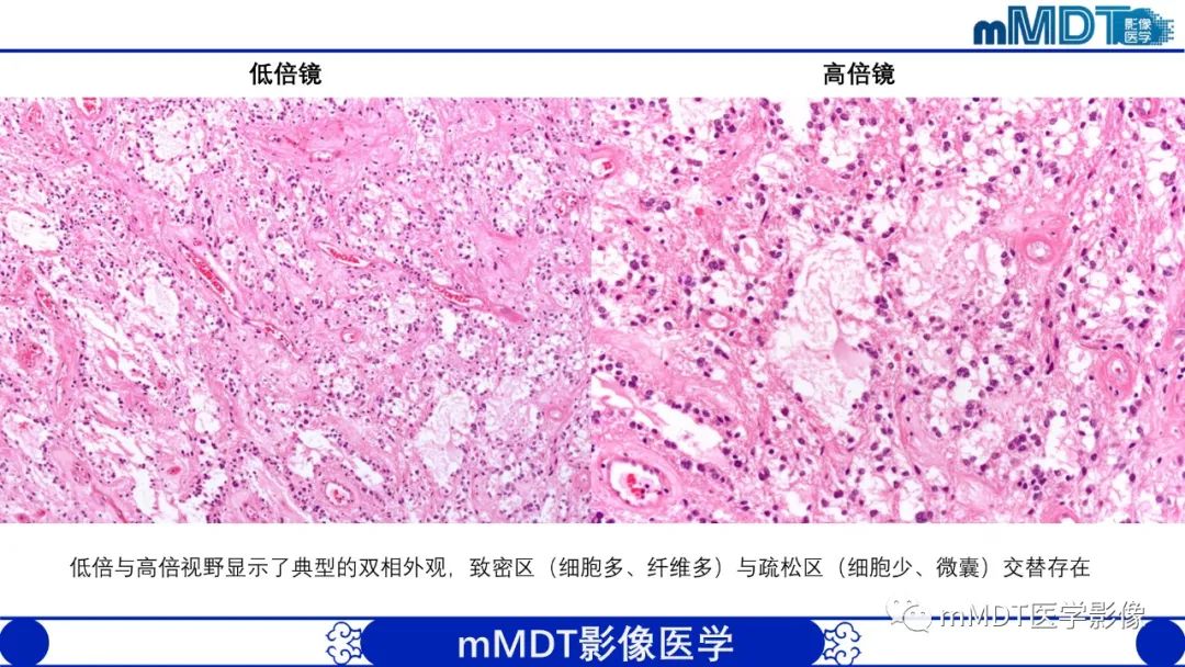 影像PPT - 【病例】脑室内毛细胞星形细胞瘤伴室管膜下转移1例MR影像-18