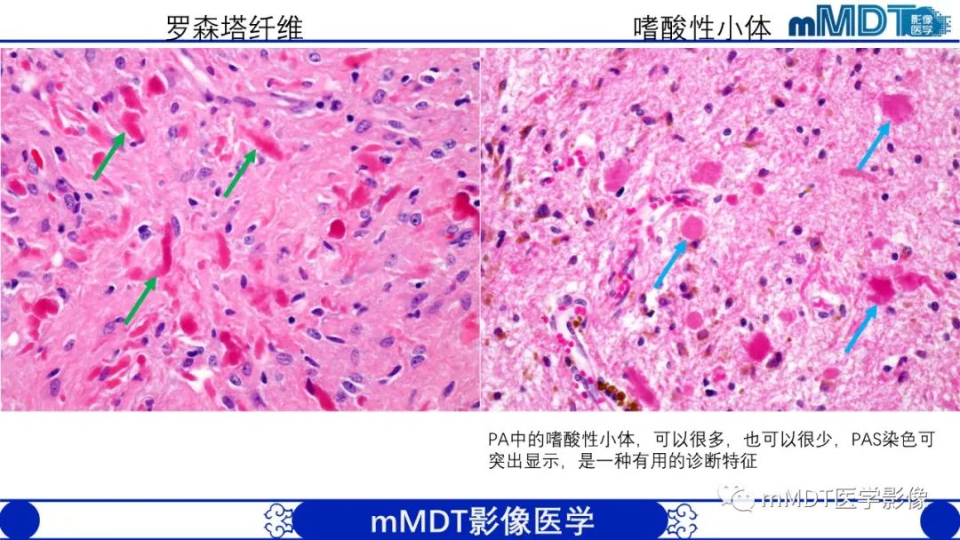 影像PPT - 【病例】脑室内毛细胞星形细胞瘤伴室管膜下转移1例MR影像-19