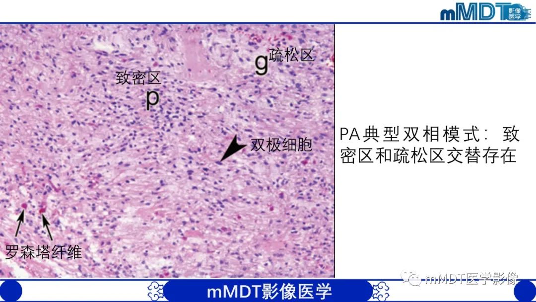 影像PPT - 【病例】脑室内毛细胞星形细胞瘤伴室管膜下转移1例MR影像-20