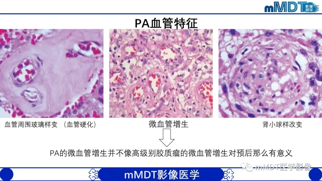 影像PPT - 【病例】脑室内毛细胞星形细胞瘤伴室管膜下转移1例MR影像-21