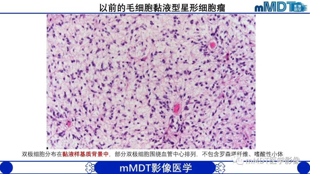 影像PPT - 【病例】脑室内毛细胞星形细胞瘤伴室管膜下转移1例MR影像-22