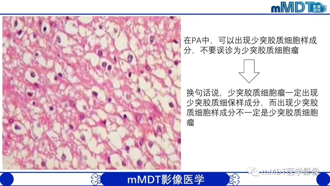 影像PPT - 【病例】脑室内毛细胞星形细胞瘤伴室管膜下转移1例MR影像-23