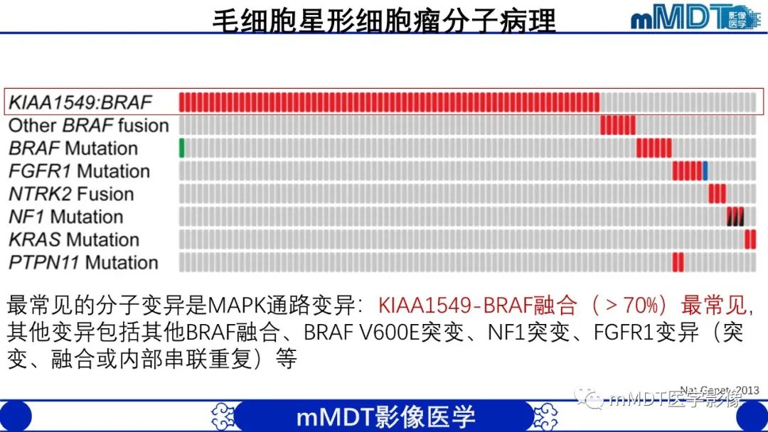 影像PPT - 【病例】脑室内毛细胞星形细胞瘤伴室管膜下转移1例MR影像-24