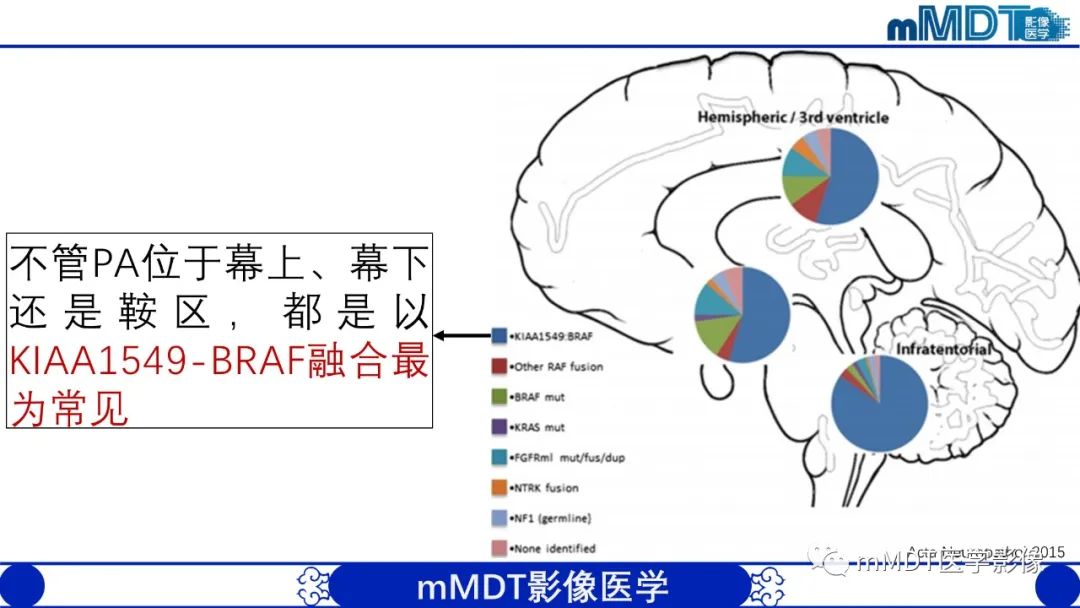 影像PPT - 【病例】脑室内毛细胞星形细胞瘤伴室管膜下转移1例MR影像-28