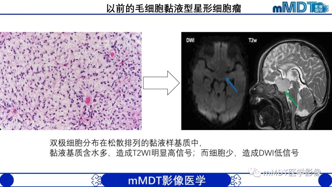 影像PPT - 【病例】脑室内毛细胞星形细胞瘤伴室管膜下转移1例MR影像-30