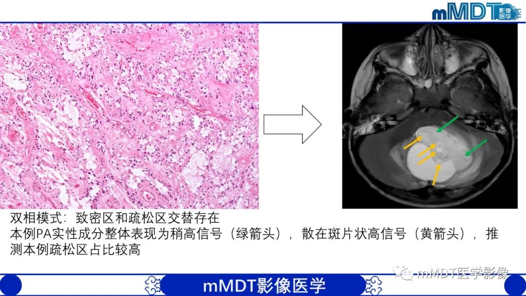影像PPT - 【病例】脑室内毛细胞星形细胞瘤伴室管膜下转移1例MR影像-31