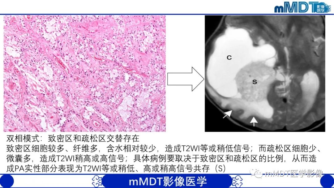 影像PPT - 【病例】脑室内毛细胞星形细胞瘤伴室管膜下转移1例MR影像-32