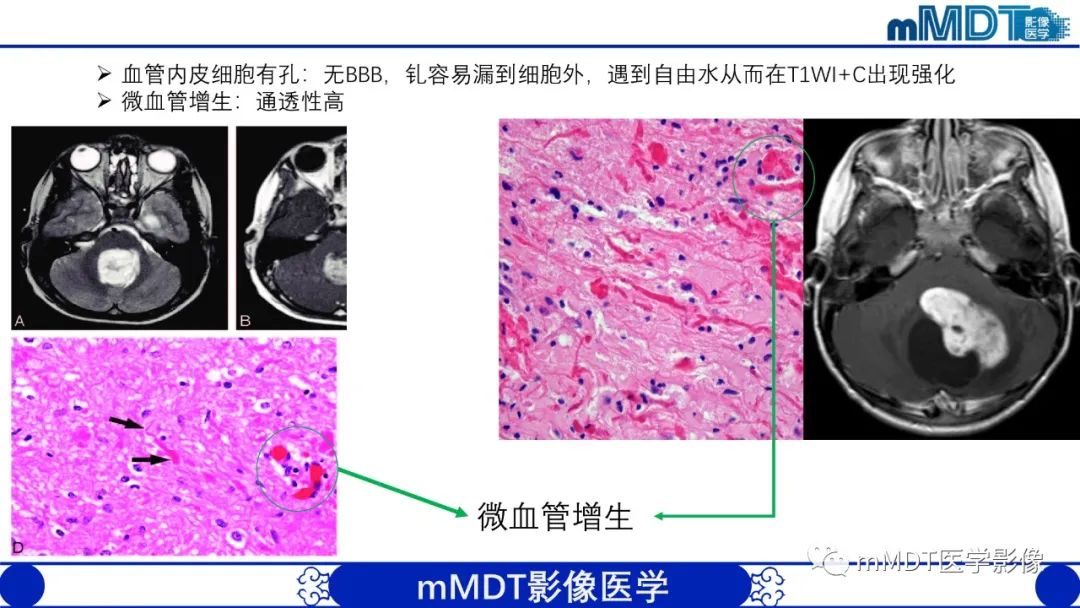 影像PPT - 【病例】脑室内毛细胞星形细胞瘤伴室管膜下转移1例MR影像-33