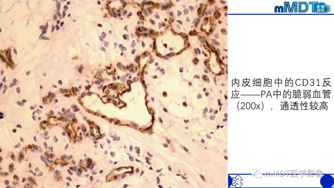 影像PPT - 【病例】脑室内毛细胞星形细胞瘤伴室管膜下转移1例MR影像-34