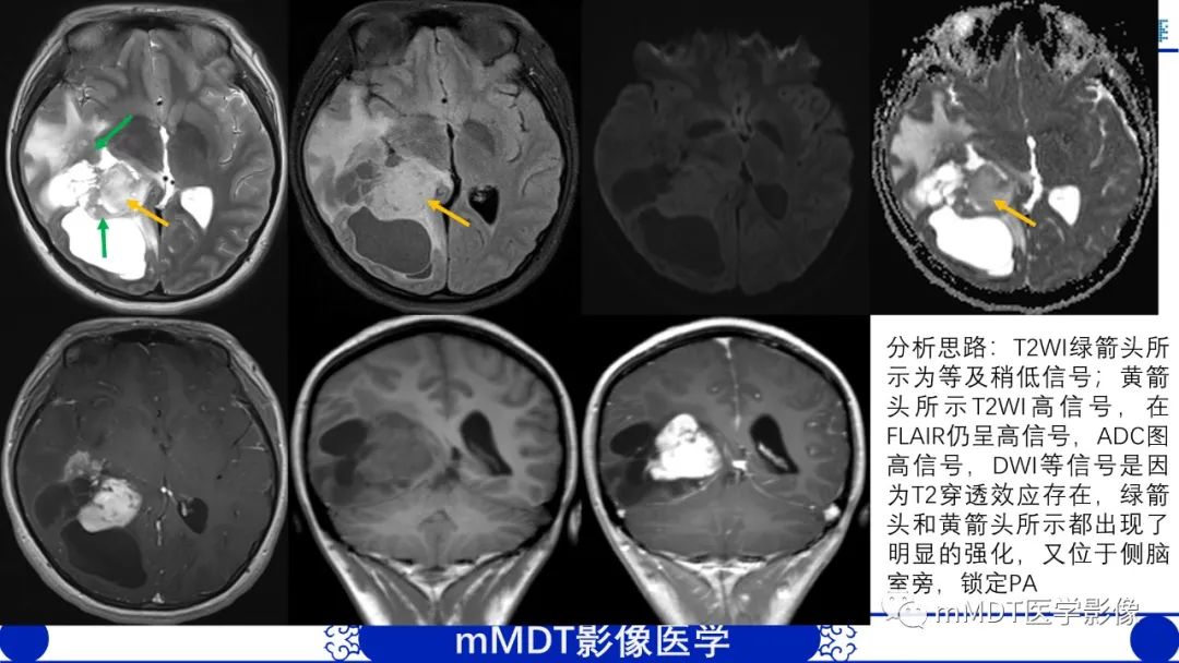 影像PPT - 【病例】脑室内毛细胞星形细胞瘤伴室管膜下转移1例MR影像-35