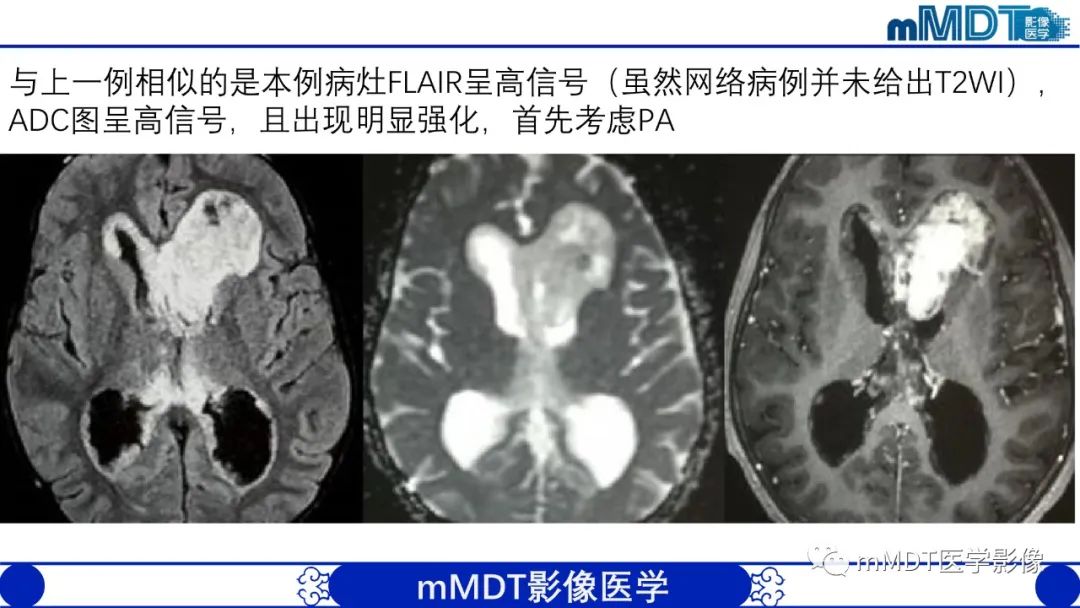 影像PPT - 【病例】脑室内毛细胞星形细胞瘤伴室管膜下转移1例MR影像-37