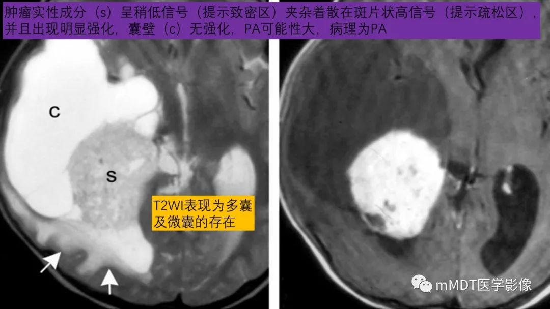影像PPT - 【病例】脑室内毛细胞星形细胞瘤伴室管膜下转移1例MR影像-38