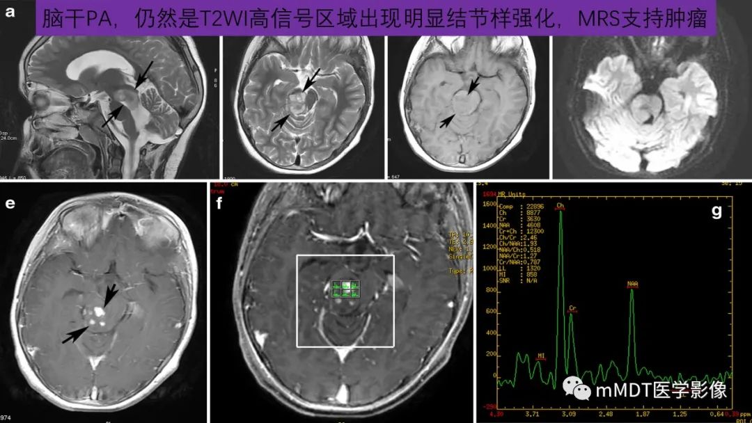 影像PPT - 【病例】脑室内毛细胞星形细胞瘤伴室管膜下转移1例MR影像-39