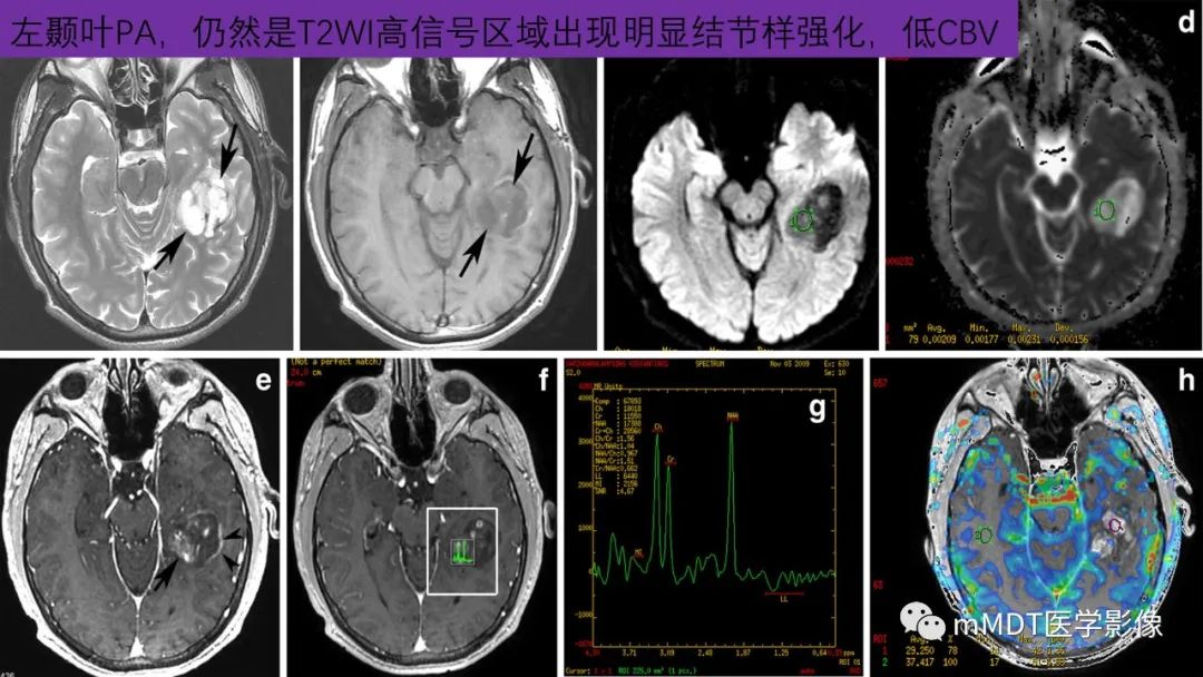 影像PPT - 【病例】脑室内毛细胞星形细胞瘤伴室管膜下转移1例MR影像-40