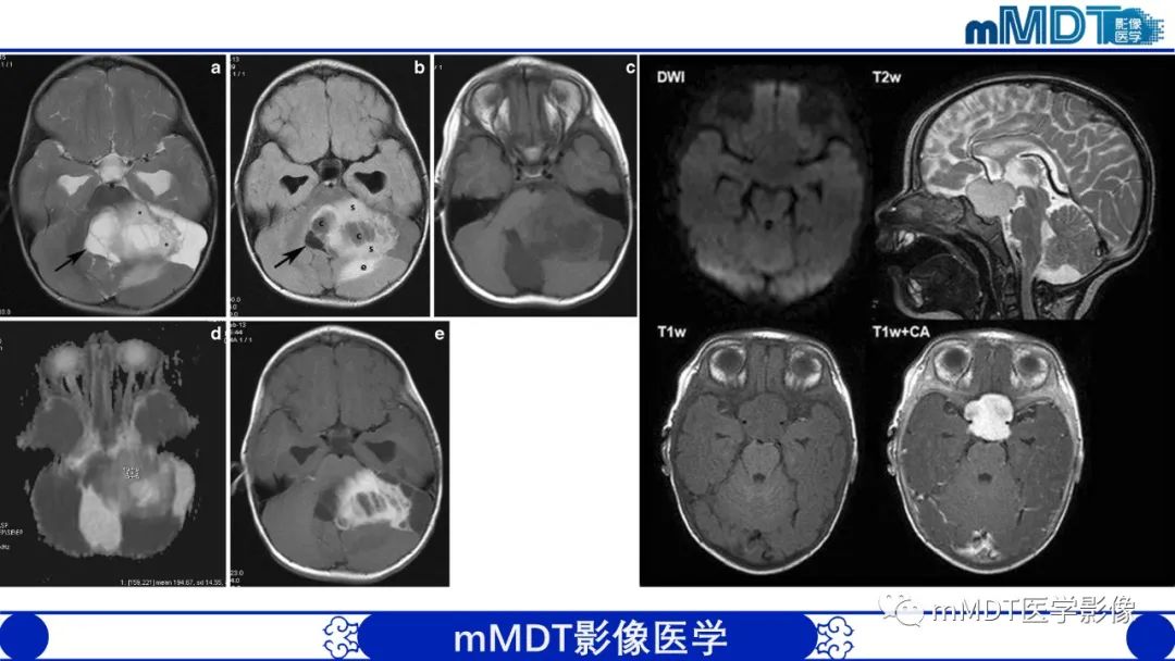 影像PPT - 【病例】脑室内毛细胞星形细胞瘤伴室管膜下转移1例MR影像-42