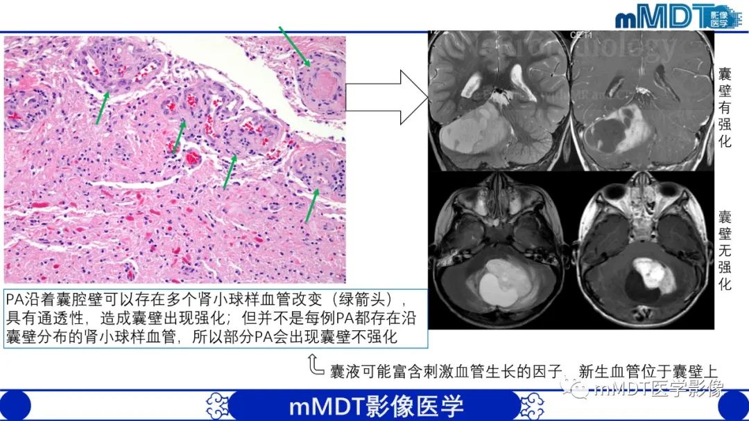 影像PPT - 【病例】脑室内毛细胞星形细胞瘤伴室管膜下转移1例MR影像-44