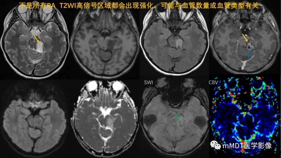 影像PPT - 【病例】脑室内毛细胞星形细胞瘤伴室管膜下转移1例MR影像-45