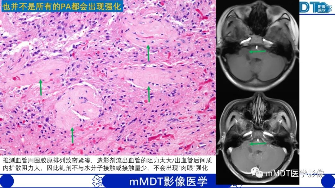 影像PPT - 【病例】脑室内毛细胞星形细胞瘤伴室管膜下转移1例MR影像-46