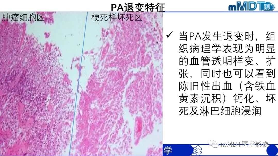 影像PPT - 【病例】脑室内毛细胞星形细胞瘤伴室管膜下转移1例MR影像-48