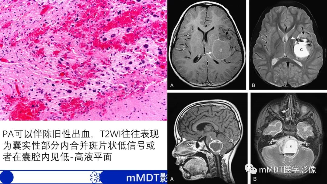 影像PPT - 【病例】脑室内毛细胞星形细胞瘤伴室管膜下转移1例MR影像-49