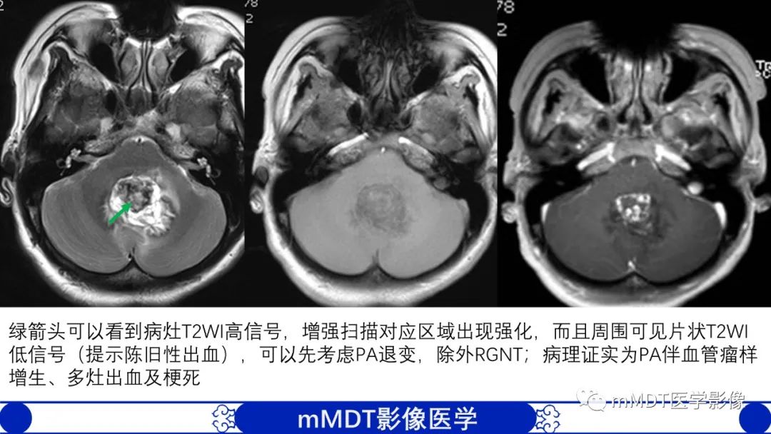 影像PPT - 【病例】脑室内毛细胞星形细胞瘤伴室管膜下转移1例MR影像-50