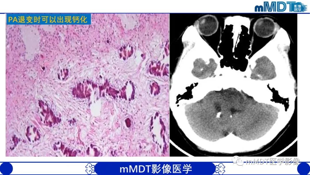 影像PPT - 【病例】脑室内毛细胞星形细胞瘤伴室管膜下转移1例MR影像-51