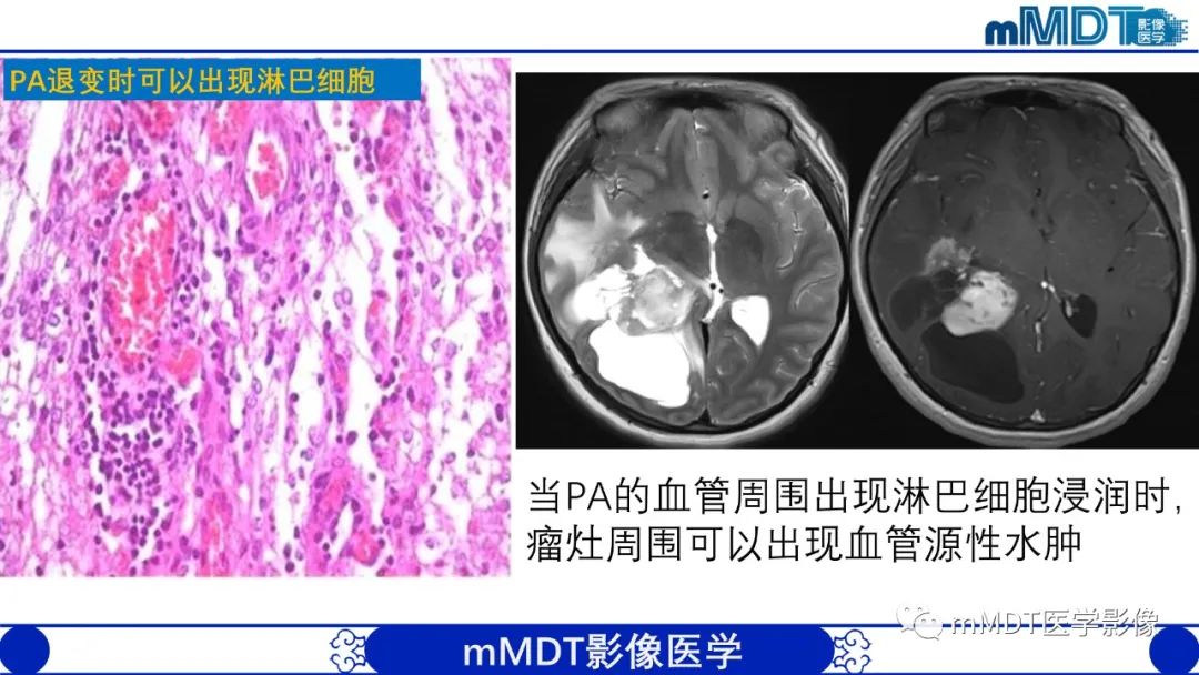 影像PPT - 【病例】脑室内毛细胞星形细胞瘤伴室管膜下转移1例MR影像-52