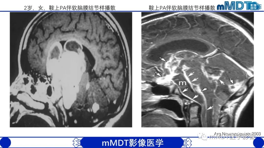 影像PPT - 【病例】脑室内毛细胞星形细胞瘤伴室管膜下转移1例MR影像-54